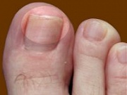 Лечение грибка ногтей препаратами корпорации "Виталайн"